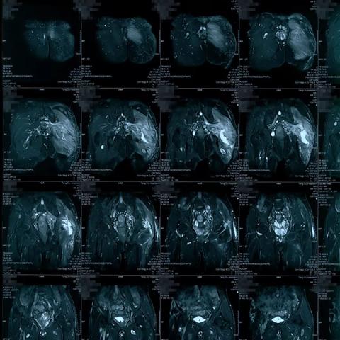 神经纤维瘤最新希望综述报告